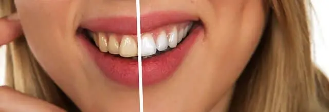 PICTURE OF TEETH 