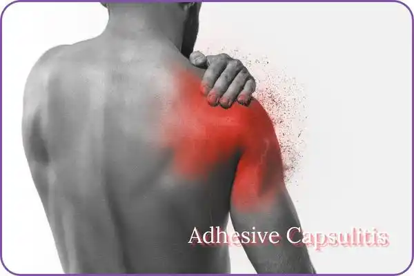 adhesive capsulitis in a male patient .