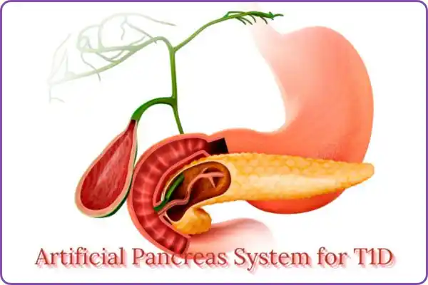 ARTIFICIAL PANCREAS SYSTEM FOR T1D